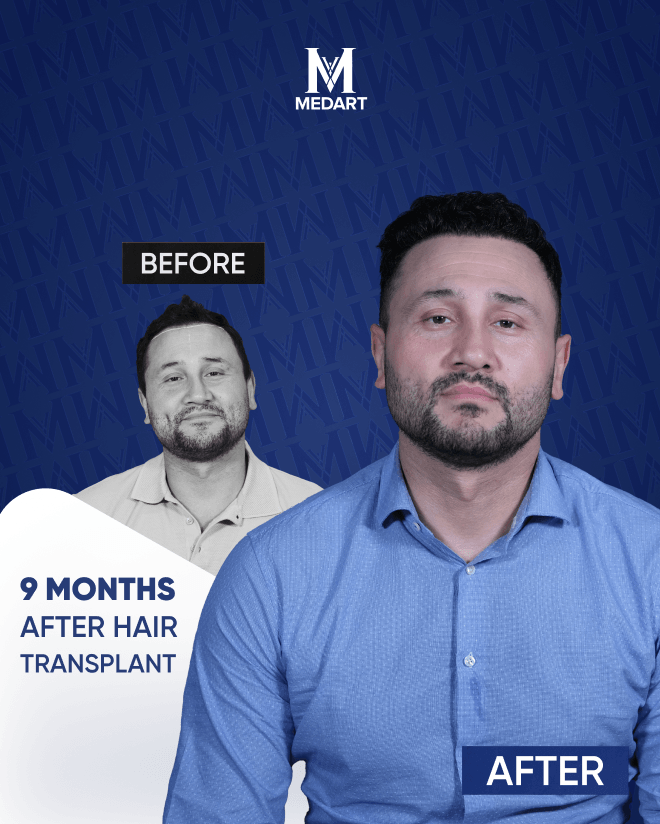 Before After 3