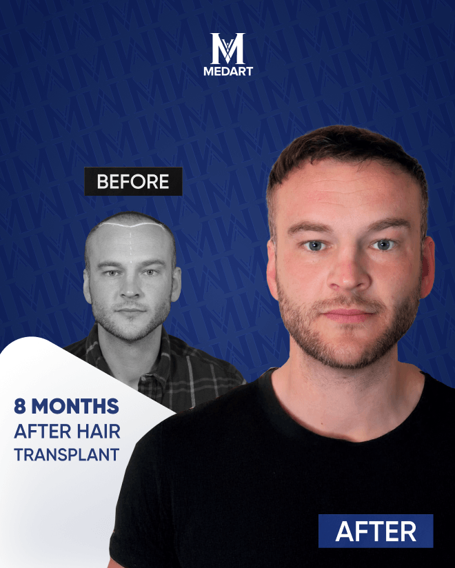 Before After 7