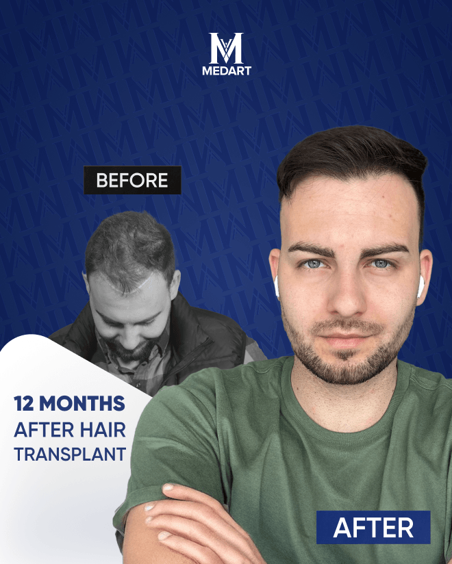 Before After 10