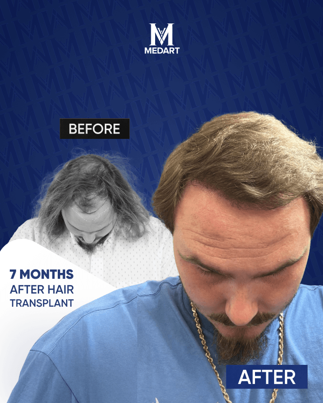 Before After 11