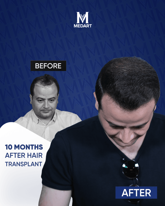 Before After 12
