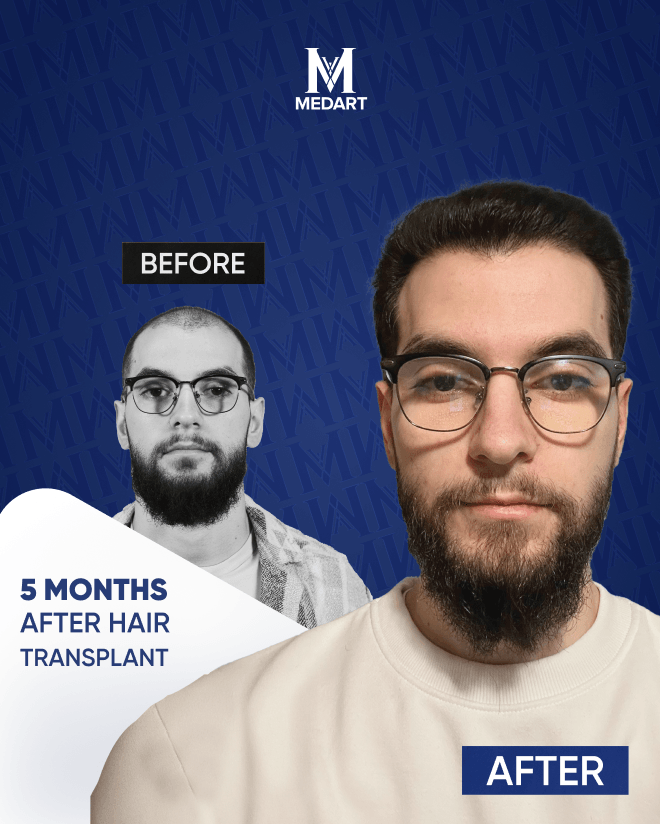 Before After 13