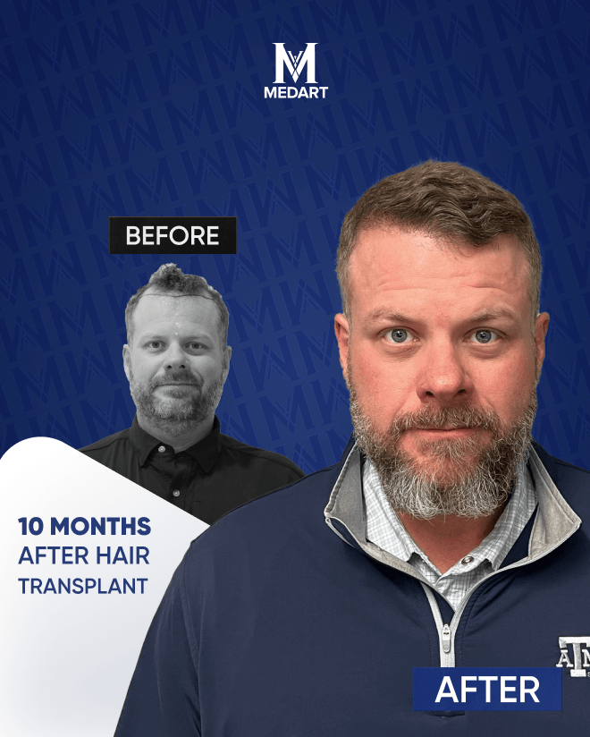 Before After 1