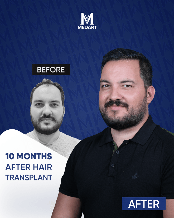 Before After 8