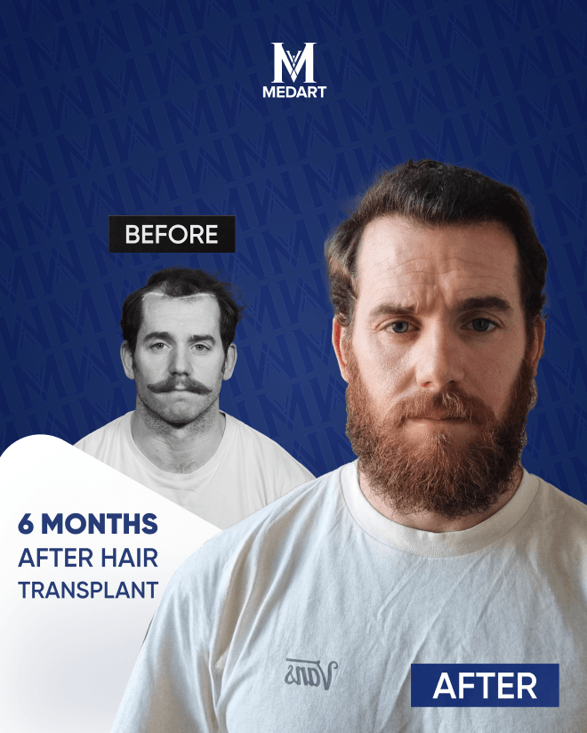 Before After 4