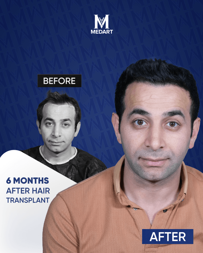Before After 5