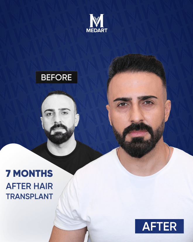 Before After 6